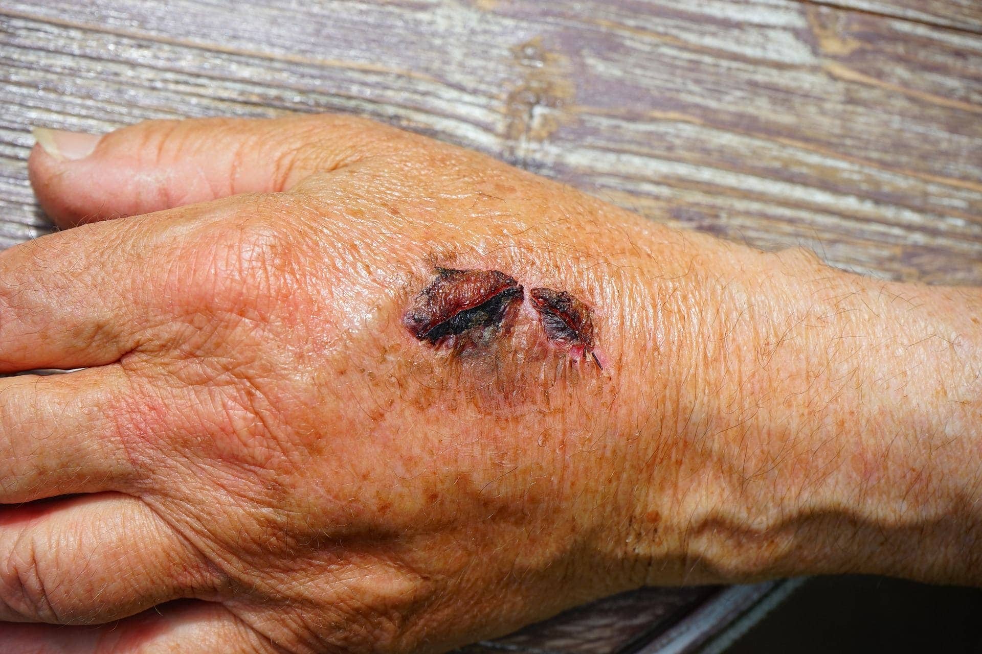 Trudno gojące się rany – dlaczego powstają i jak je leczyć?